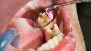 diente en mitad de una endodoncia