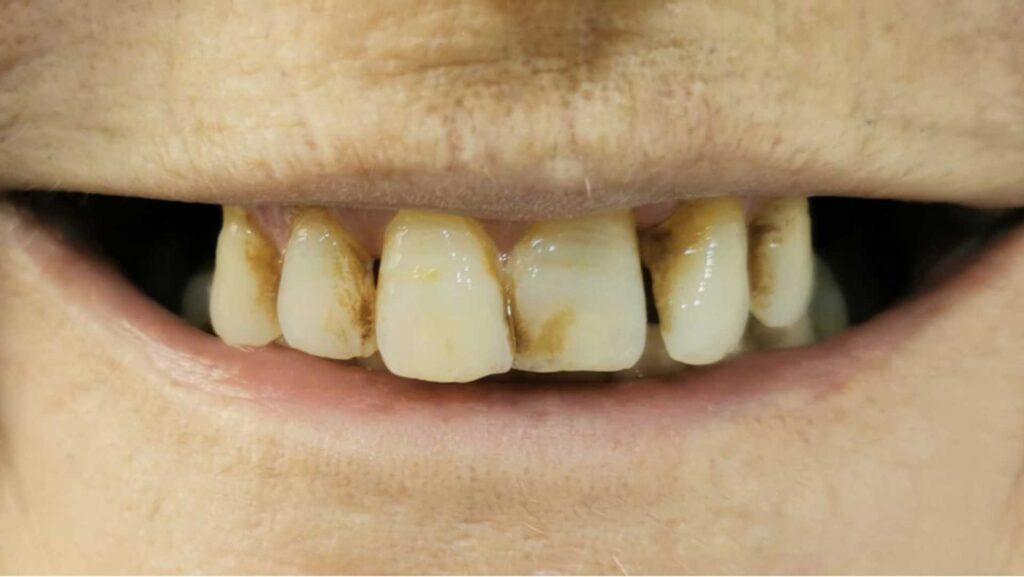 tratamientos estéticos dentales: dientes amarillos