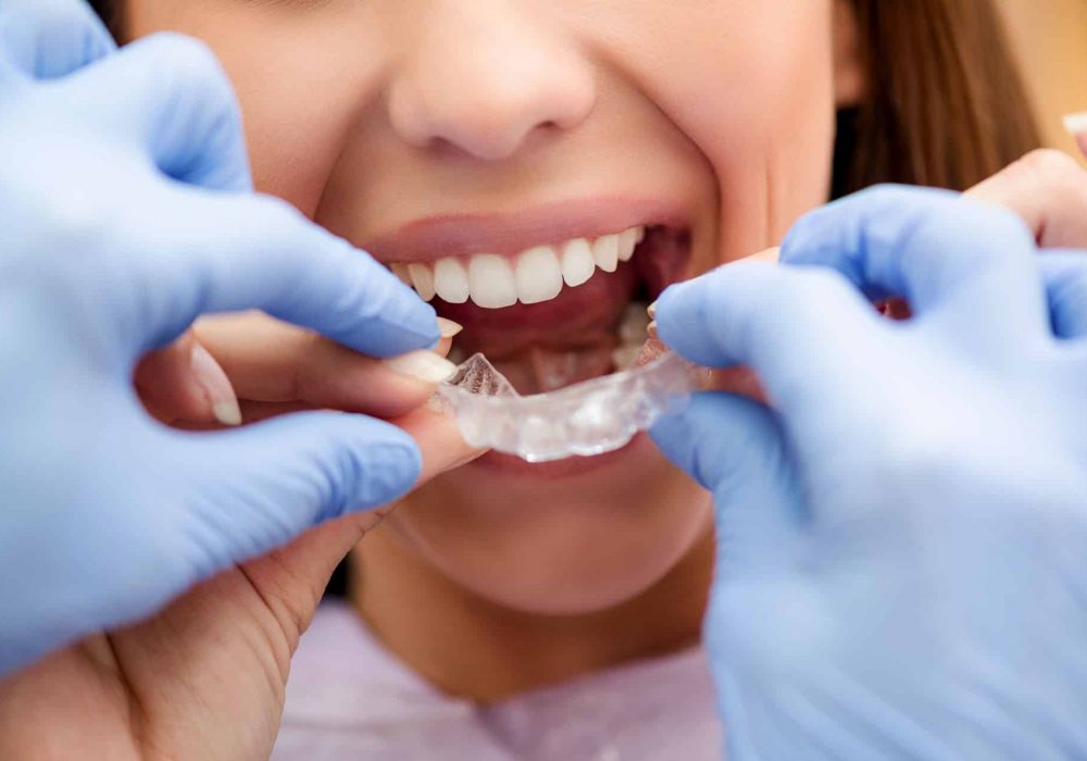 paciente poniéndose su ortodoncia invisible o invisalign